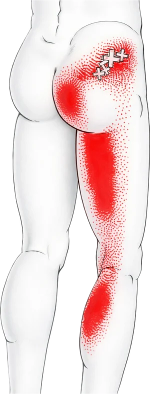 Αντανάκλαση πόνου στο κάτω άκρο λόγω κήλης μεσοσπονδυλίου δίσκου