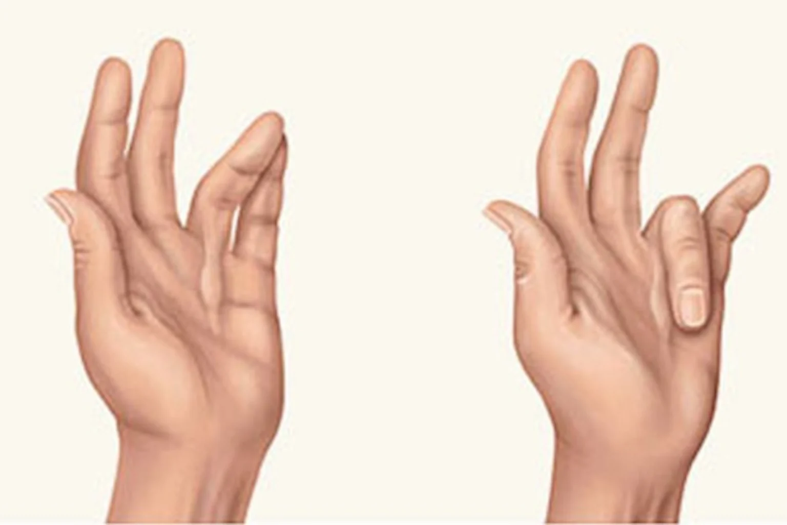 νόσος dupuytren